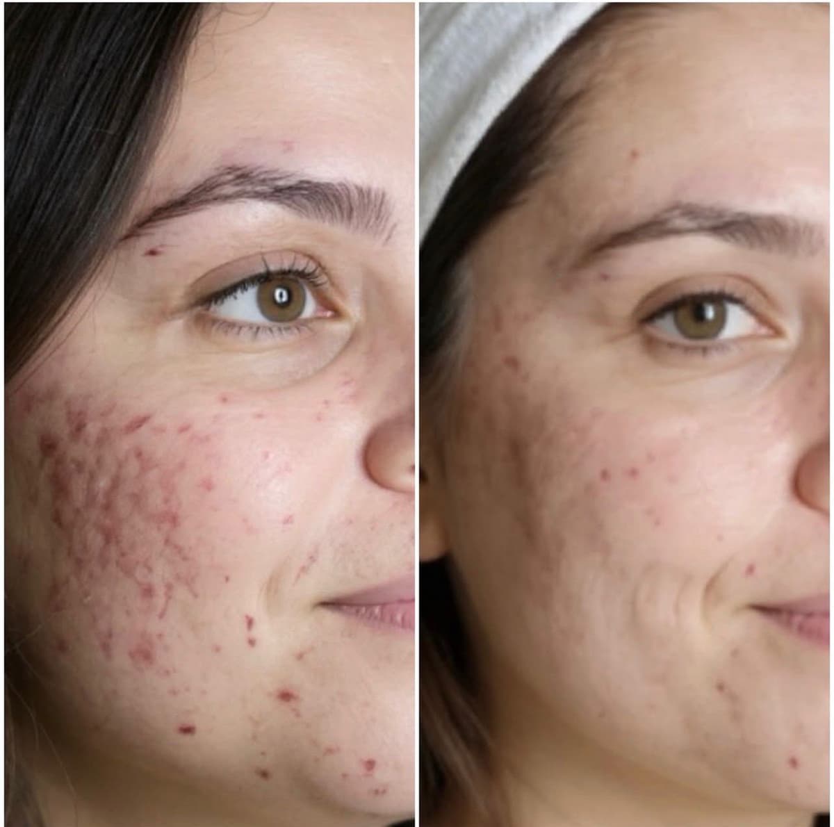 Cicatriz de Acne