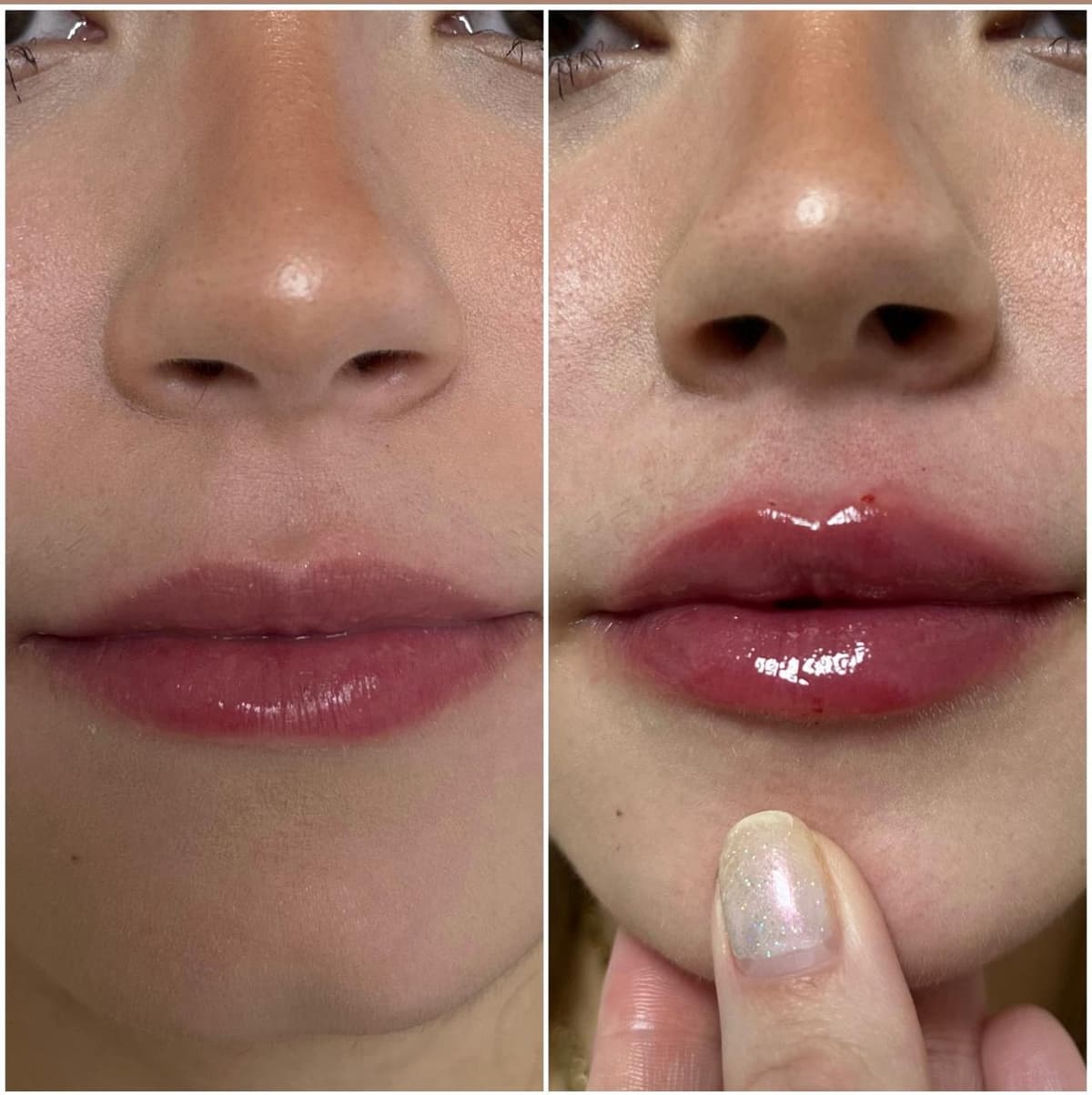 Preenchimento Labial